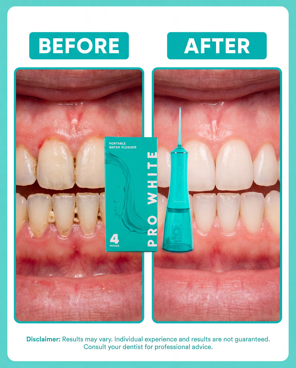 Pro White Portable Water Flosser — before and after results