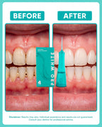 Pro White Portable Water Flosser — before and after results