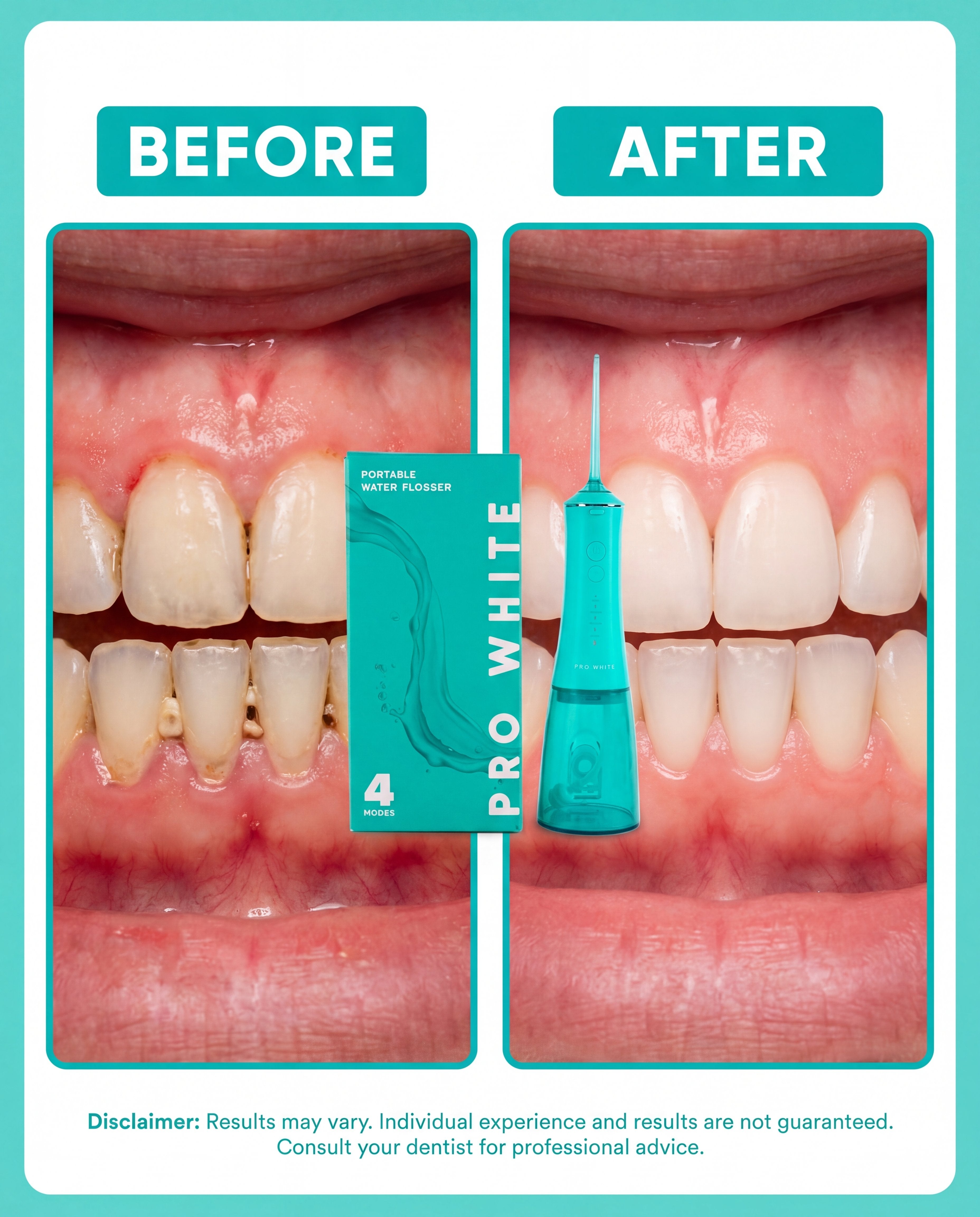Pro White Portable Water Flosser — before and after results